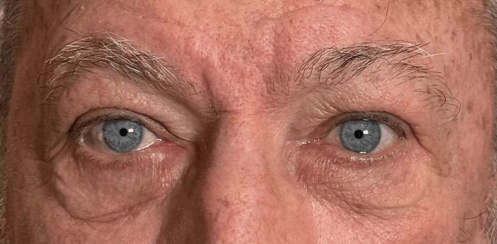 Upper and Lower Lid Cosmetic Blepharoplasty Before