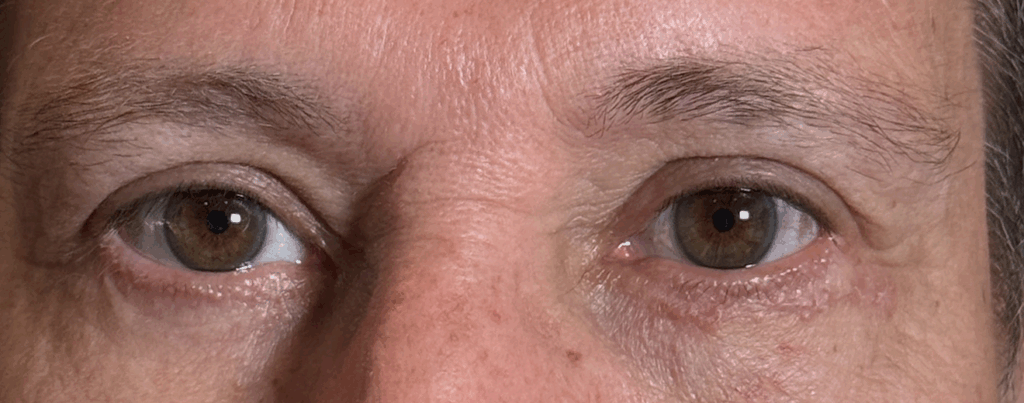 Upper Lid Blepharoplasty with Fat Transposition Lower Lid Blepharoplasty with Fat Subtraction & Transposition After