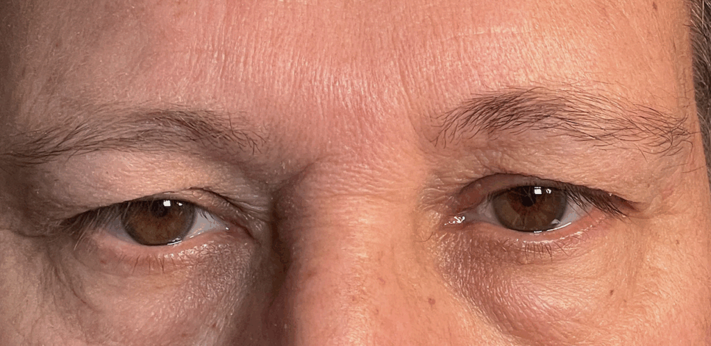 Upper Lid Blepharoplasty with Fat Transposition Lower Lid Blepharoplasty with Fat Subtraction & Transposition Before