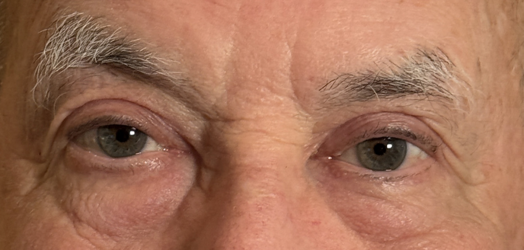 Cosmetic Blepharoplasty Upper Lids MMCR Ptosis Repair Both Upper Lids After