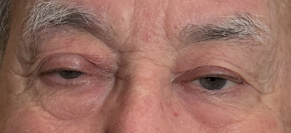 Cosmetic Blepharoplasty Upper Lids MMCR Ptosis Repair Both Upper Lids Before