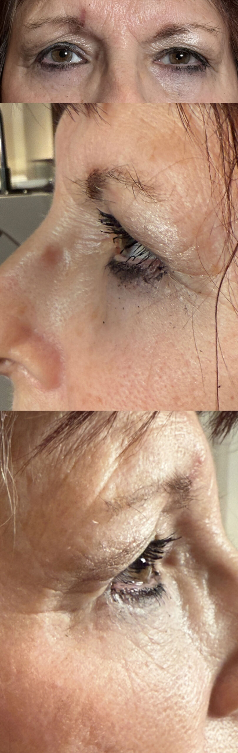 Lower Lid Blepharoplasty Both Lower Lids Fat Subtraction and Lower Lid Fat Bags Removal After