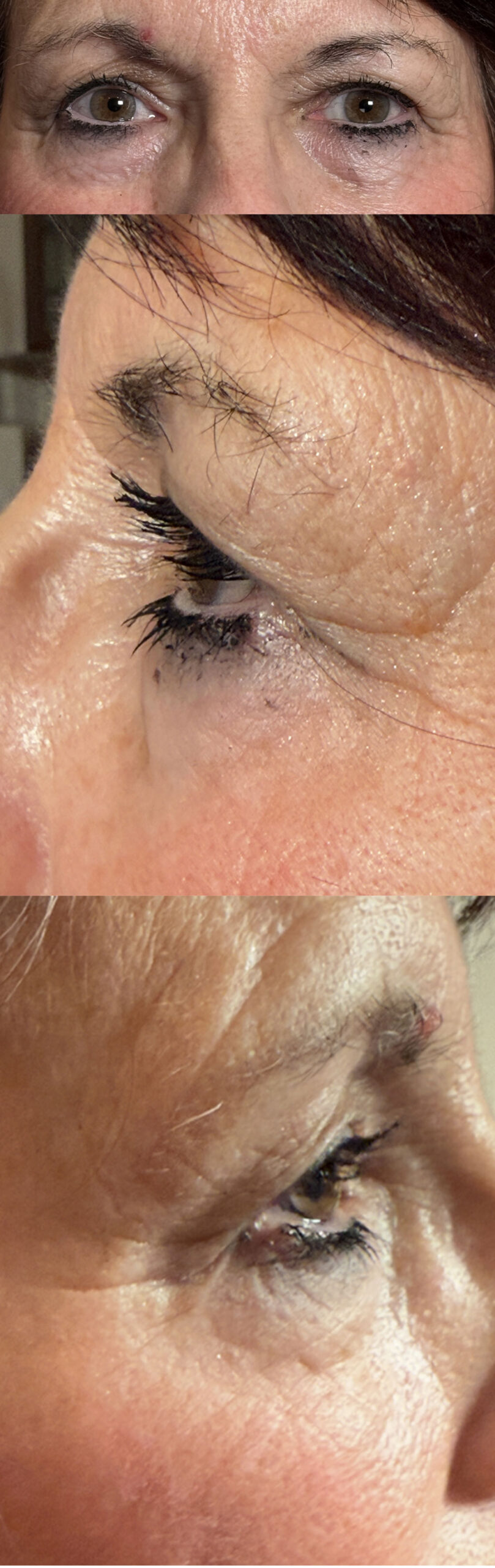 Lower Lid Blepharoplasty Both Lower Lids Fat Subtraction and Lower Lid Fat Bags Removal Before