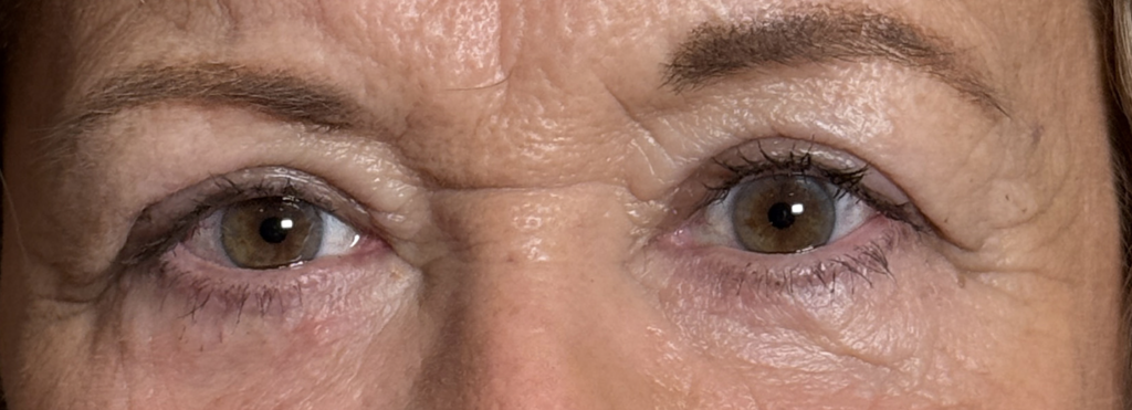 Cosmetic Blepharoplasty Upper and Lower Lids After