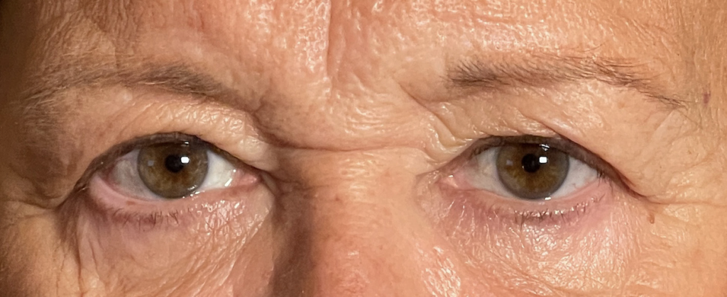 Cosmetic Blepharoplasty Upper and Lower Lids Before