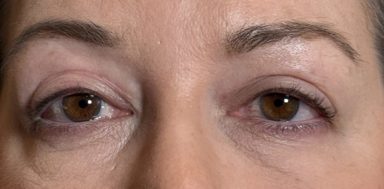 Cosmetic Blepharoplasty BULs After