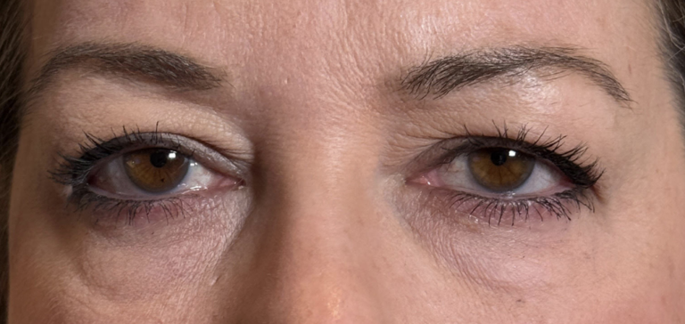 Cosmetic Blepharoplasty BULs Before