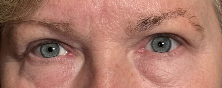 Cosmetic Blepharoplasty BULs After