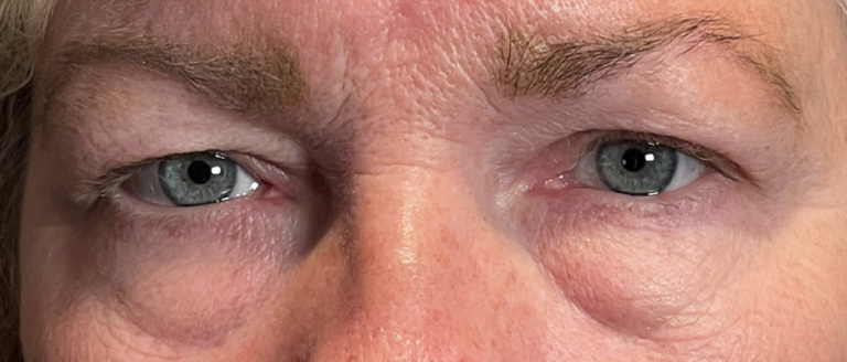 Cosmetic Blepharoplasty BULs Before
