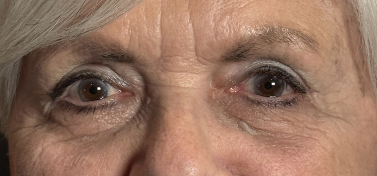 Cosmetic Blepharoplasty BULs After