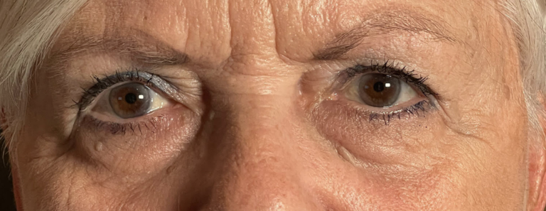 Cosmetic Blepharoplasty BULs Before