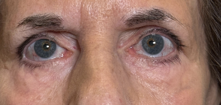 Blepharoplasty Both Lower Lids After