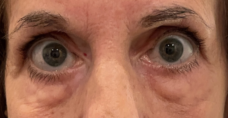 Blepharoplasty Both Lower Lids Before
