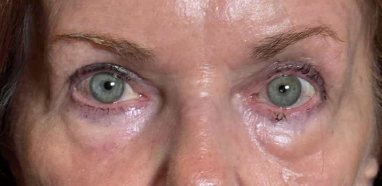 Ptosis Repair and Cosmetic Blepharoplasty Both Upper Lids After