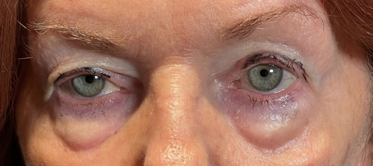 Ptosis Repair and Cosmetic Blepharoplasty Both Upper Lids Before