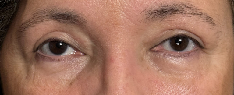 Cosmetic Blepharoplasty Both Upper Lids After