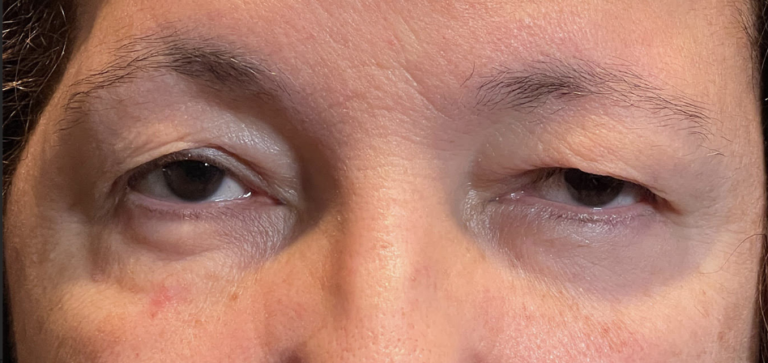 Cosmetic Blepharoplasty Both Upper Lids Before