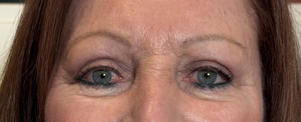 Cosmetic Blepharoplasty After