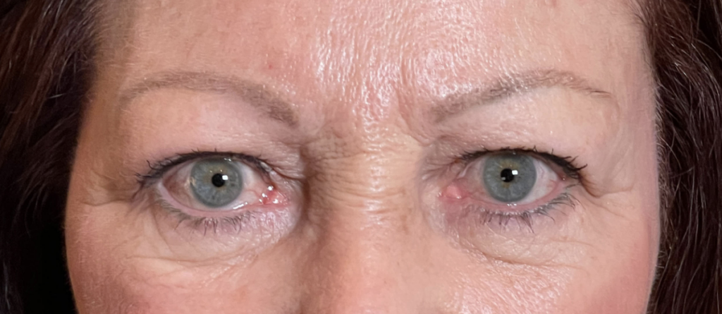 Cosmetic Blepharoplasty Before