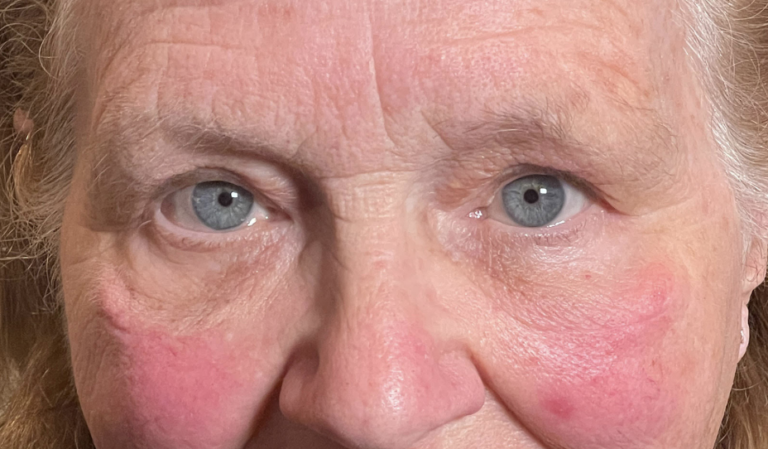 Cosmetic Upper & Lower Blepharoplasty After