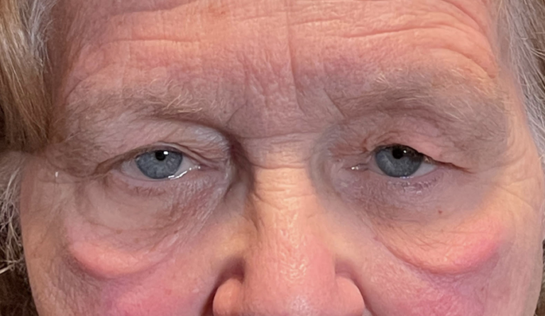 Cosmetic Upper & Lower Blepharoplasty Before