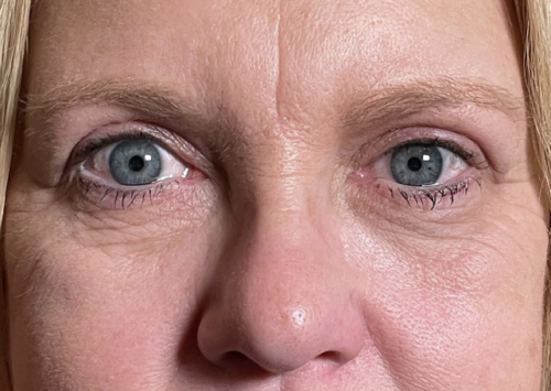 Cosmetic Blepharoplasty After
