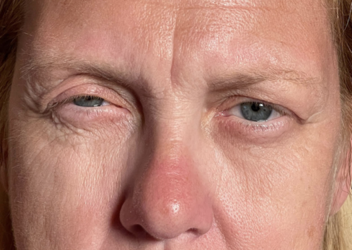 Cosmetic Blepharoplasty Before