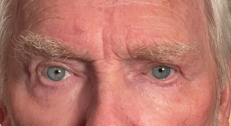 Cosmetic Blepharoplasty Both Upper Lids After