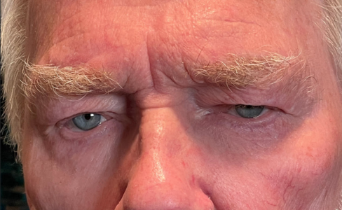 Cosmetic Blepharoplasty Both Upper Lids Before