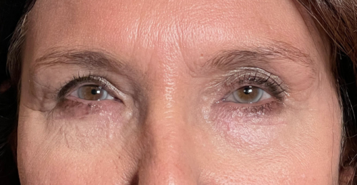 Cosmetic Blepharoplasty Both Upper and Lower Lids & Ptosis Repair. After
