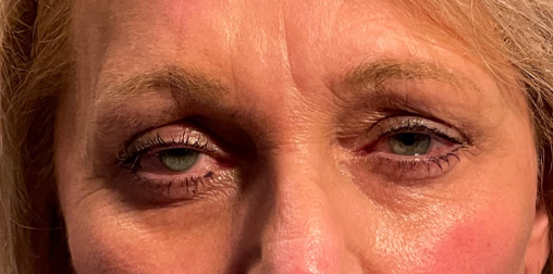 Cosmetic Blepharoplasty Upper Lids Before