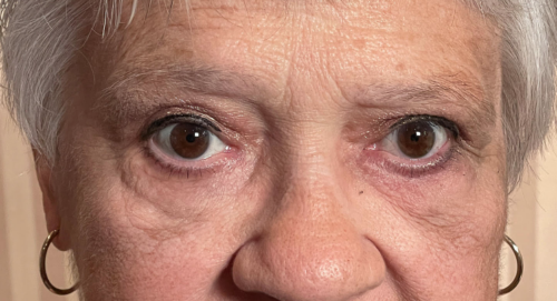 Upper and Lower Lid Cosmetic Blepharoplasty After