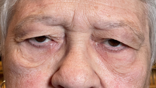 Upper and Lower Lid Cosmetic Blepharoplasty Before