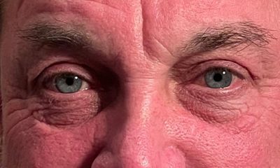 Blepharoplasty After
