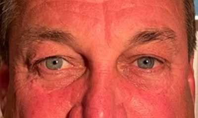 Blepharoplasty Before