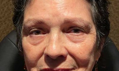 Lower Lid Blepharoplasty with Fat Transposition to Treat Infraorbital Hollows Before