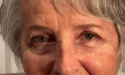 Blepharoplasty to revitalize both eyes After