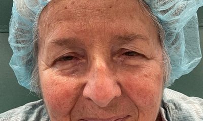 Blepharoplasty to revitalize both eyes Before