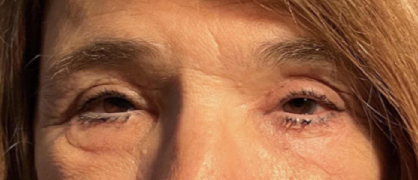 Upper & Lower Blepharoplasty After