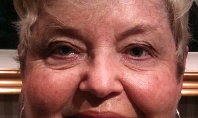 Upper & Lower Blepharoplasty Before