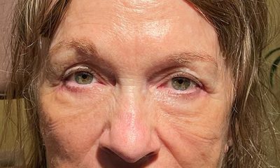 Lower Lid Blepharoplasty After