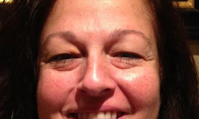 Upper Blepharoplasty to treat droopy eyelids to create a more youthful appearance. Before