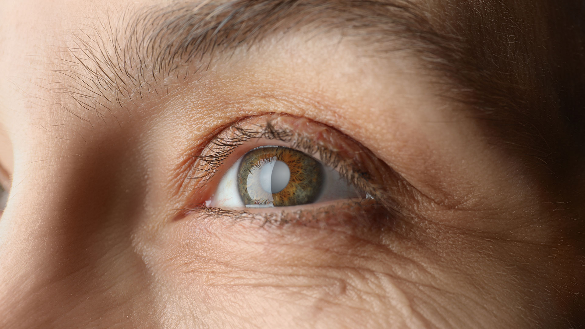 cataracts eye