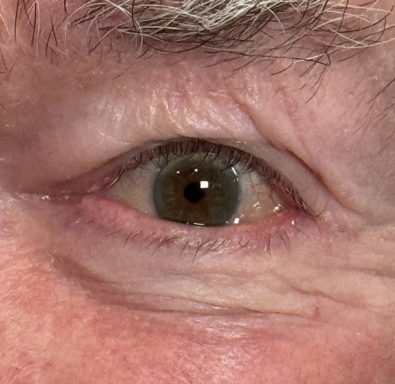 Repair Ectropion and Punctal Eversion After