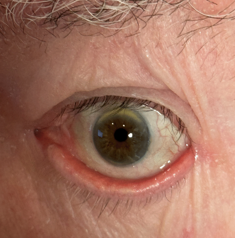 Repair Ectropion and Punctal Eversion Before