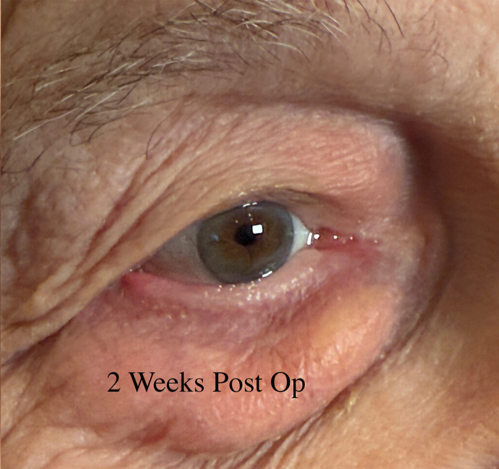 Entropion Repair After