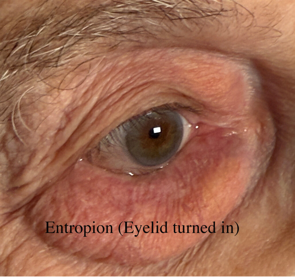 Entropion Repair Before