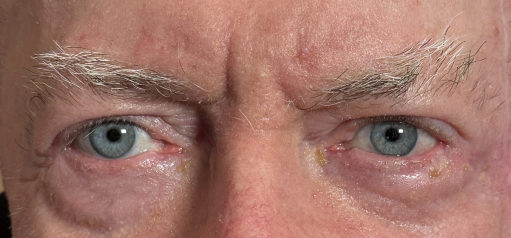 Ectropion Repair After