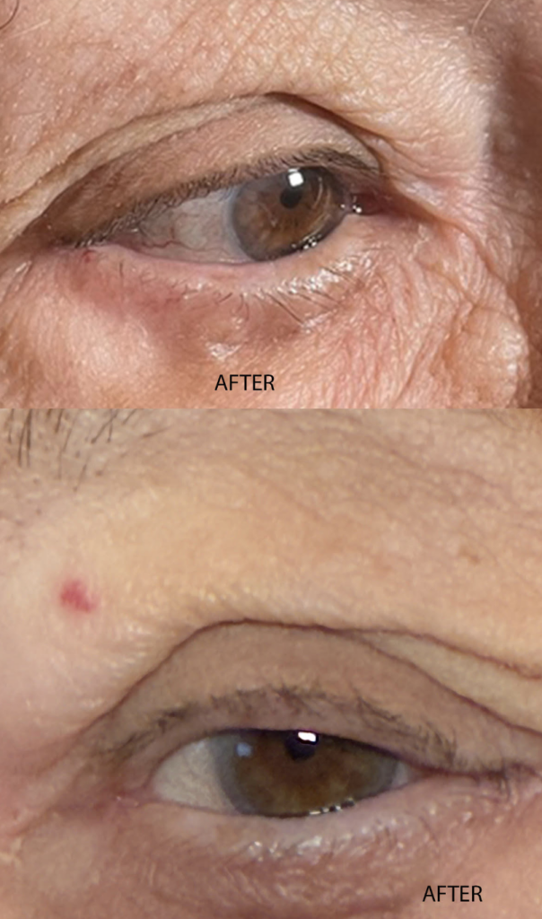 Entropion Repair After
