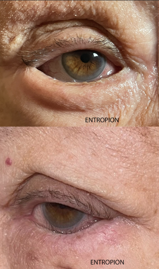 Entropion Repair Before